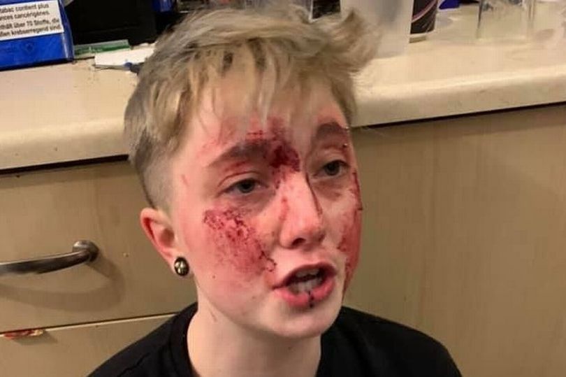 1_Bloodied-and-battered-lesbian-Charlie-Graham-has-shared-pictures-of-the-shocking-injuries-she-suffe
